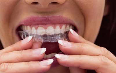 Descubre las 10 ventajas de la ortodoncia invisible